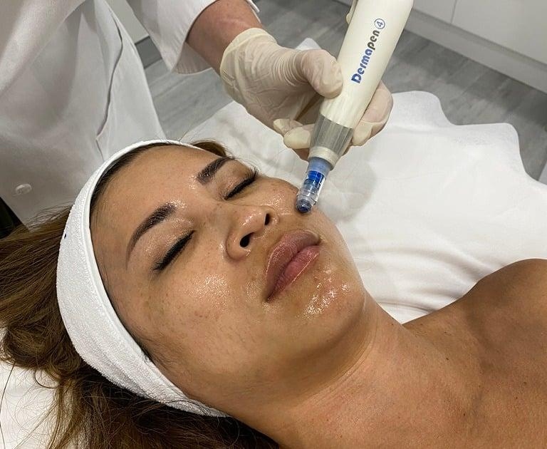 Мікронідлінг за допомогою Dermapen — сучасний підхід до професійного догляду за шкірою.